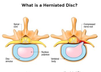 How-do-you-fix-a-Herniated-Disc
